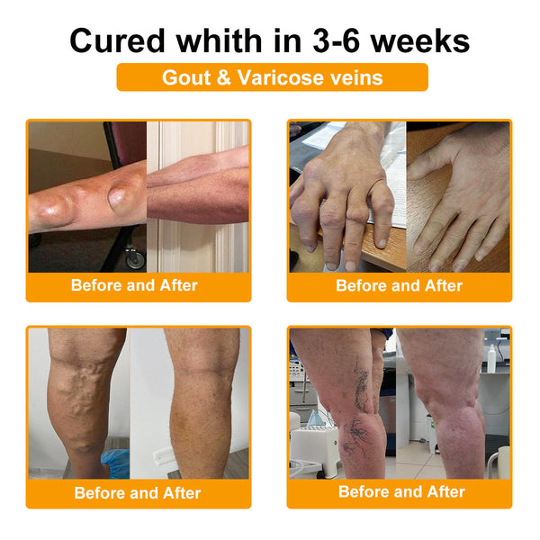 🎁Flash Sale - DENTORA WHITE™ Botulinum Toxin & Bee Venom Pain-Relief Bone Healing Cream🐝💎